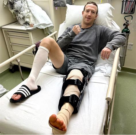 mark zuckerberg broken leg